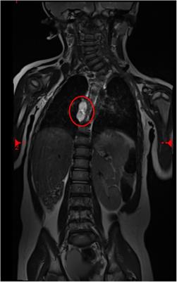 A case of double cystic esophageal duplication in VACTERL syndrome: the first case report and a review of the literature